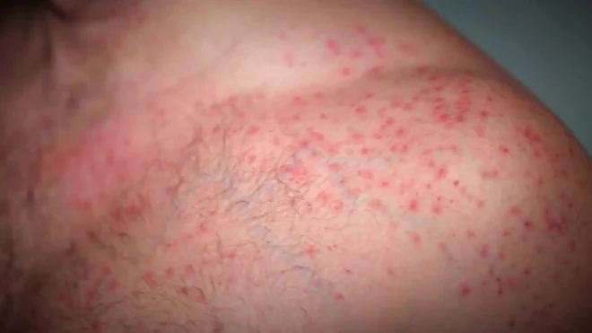 Instant Rash On Chest Rashes On Chest Causes