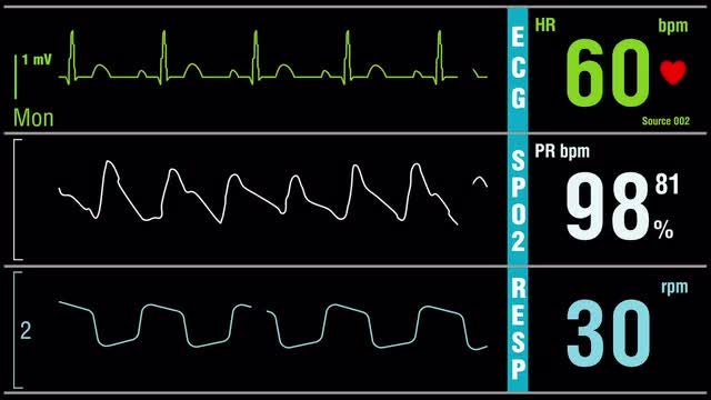Patient Monitor With Vital Signs: Stock Motion Graphics