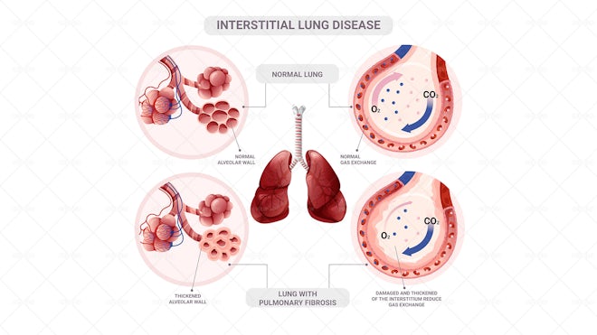 Pulmonary Fibrosis Alveoli Infographic - Graphics | Motion Array