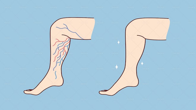 Legs With Varicose Veins - Graphics | Motion Array